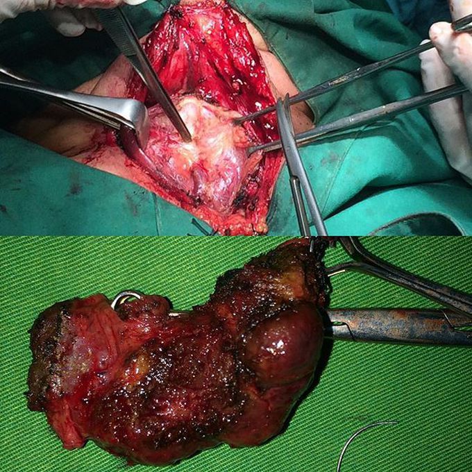 Thyroidectomy