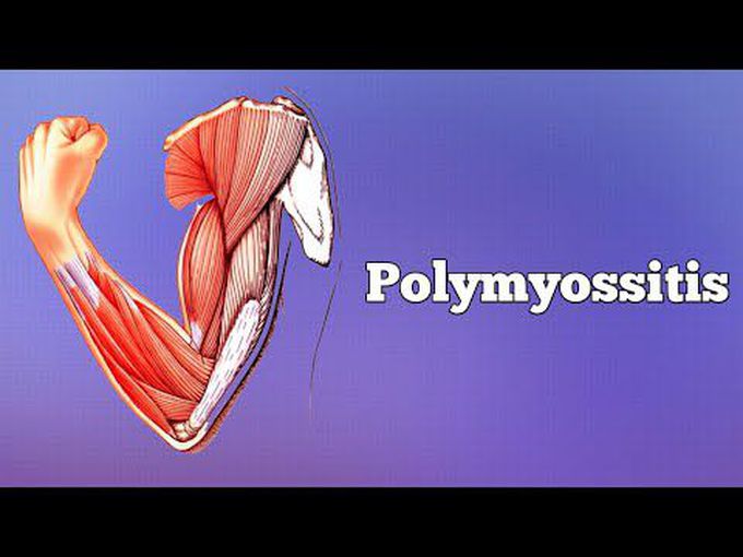 Pathology of Polymyositis and Dermatomyositis -pathology