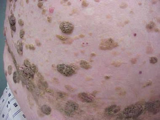 Seborrheic keratosis