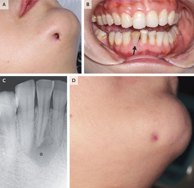 Odontogenic Cutaneous Fistula