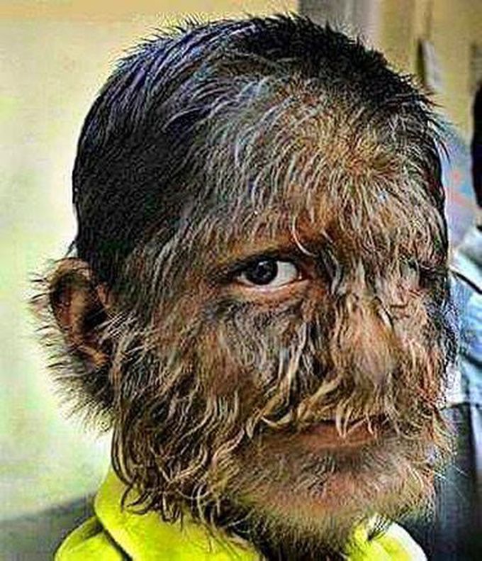 Hypertrichosis is the Excessive Growth of Hairs on the Body and Face