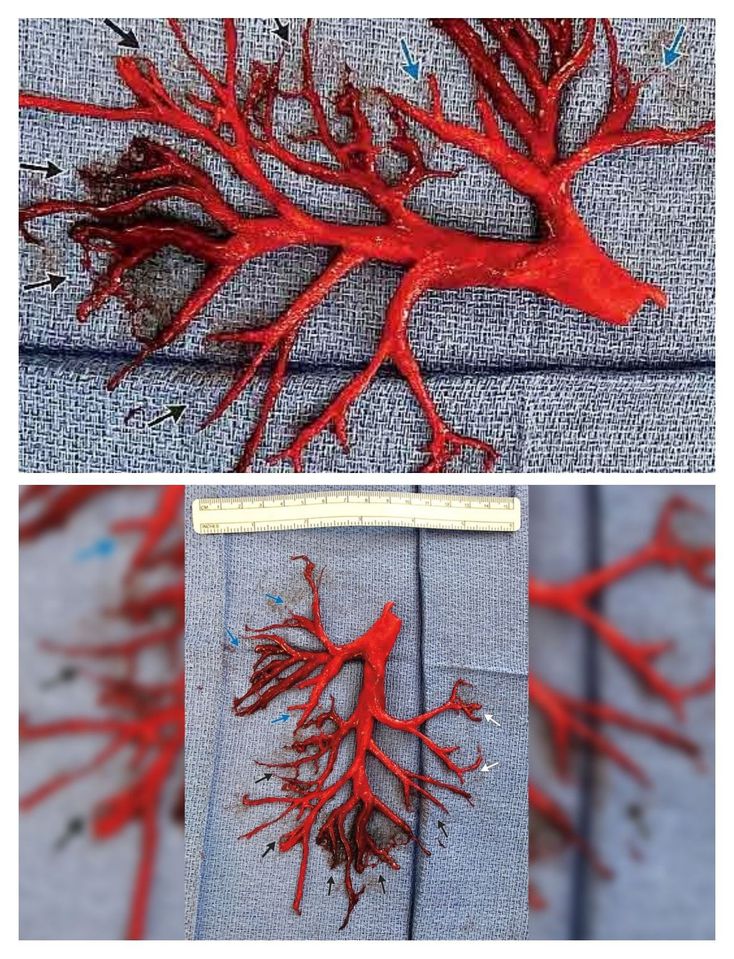 Bronchial Clot. - MEDizzy