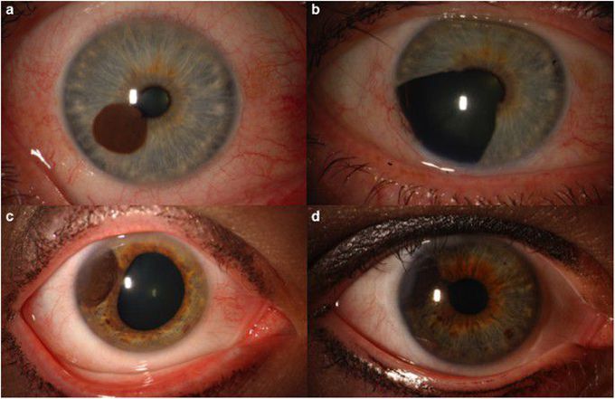 Intraocular Primary Melanoma