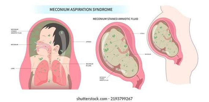 Meconium Aspiration Syndrome