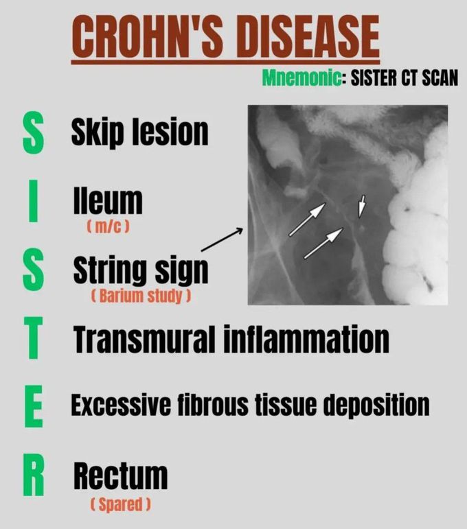 Crohn's Disease