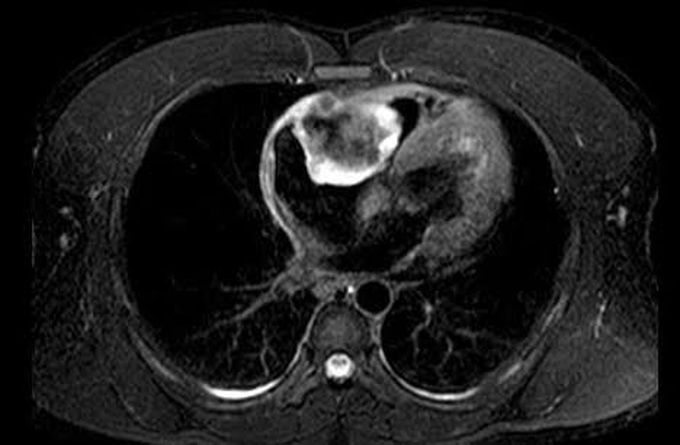 Cardiac tumour