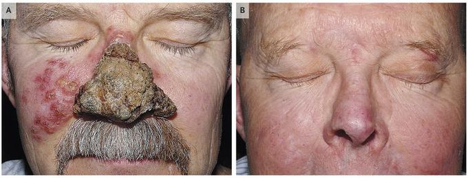 Cutaneous T-Cell Lymphoma