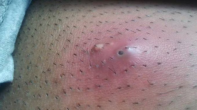 Ingrown hair cyst
