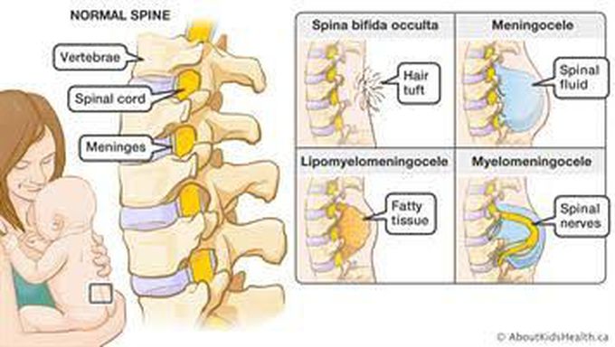 Spina bifida