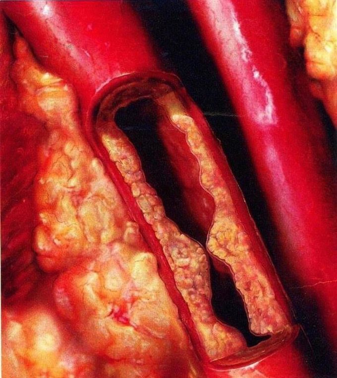 Atherosclerosis 