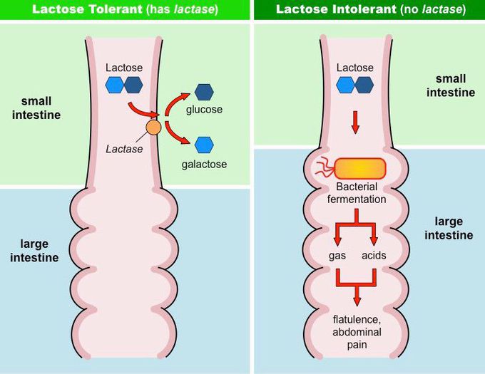 Lactose Intolerance