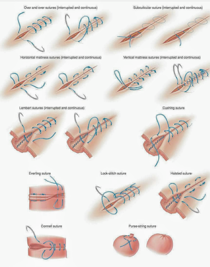 Different types of Surgical suturing techniques.