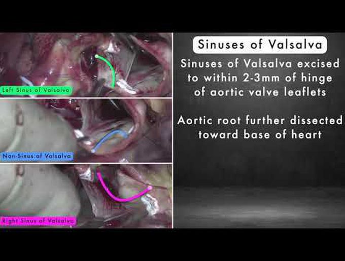 Valve-Sparing Aortic Root Replacement in Loeys-Dietz Patient