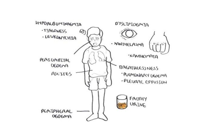 Symptoms of Nephrotic Syndrome