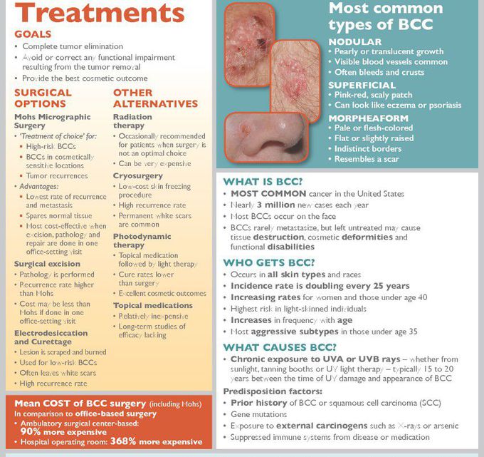 Treatment for basal cell carcinoma - MEDizzy