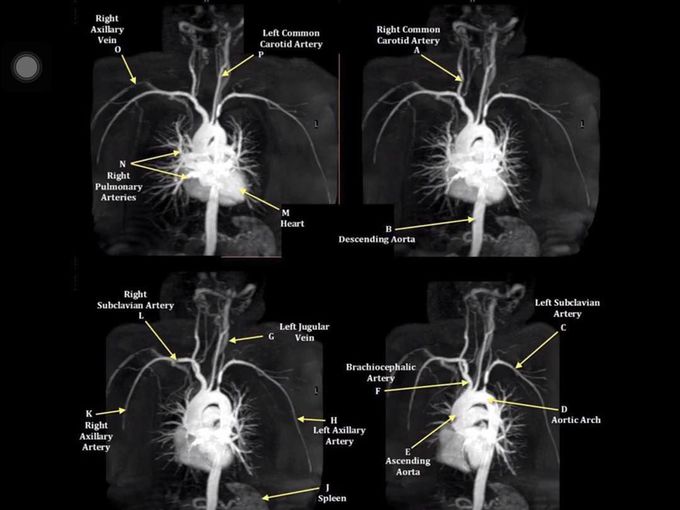 CE MRA of the subclavian arteries