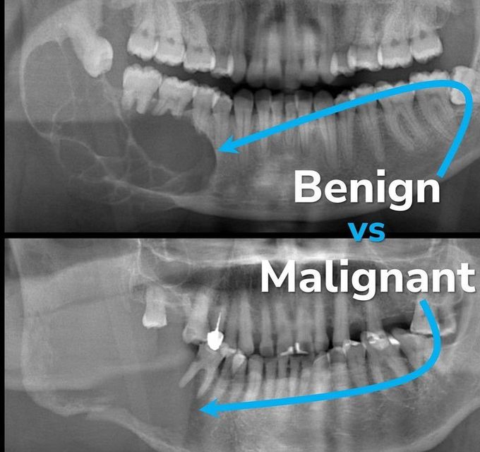 Benign Vs Malignant