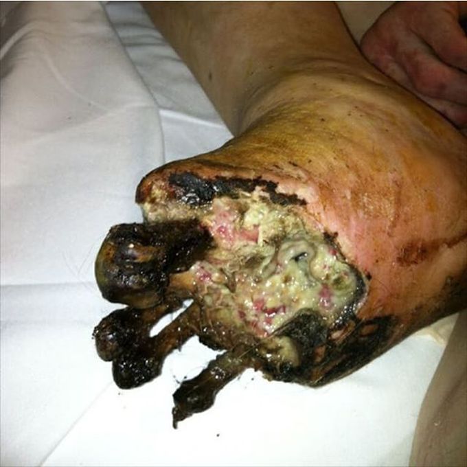 Gangrene of a diabetic foot that got infected over time!