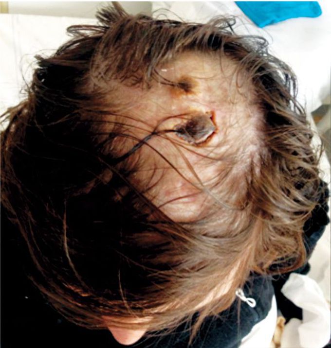 Scalp lesions