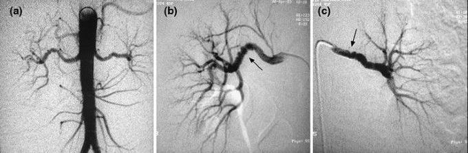 String of Beads- Fibromuscular dysplasia of the renal arteries