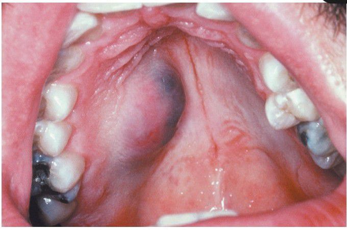 Mucoepidermoid Carcinoma