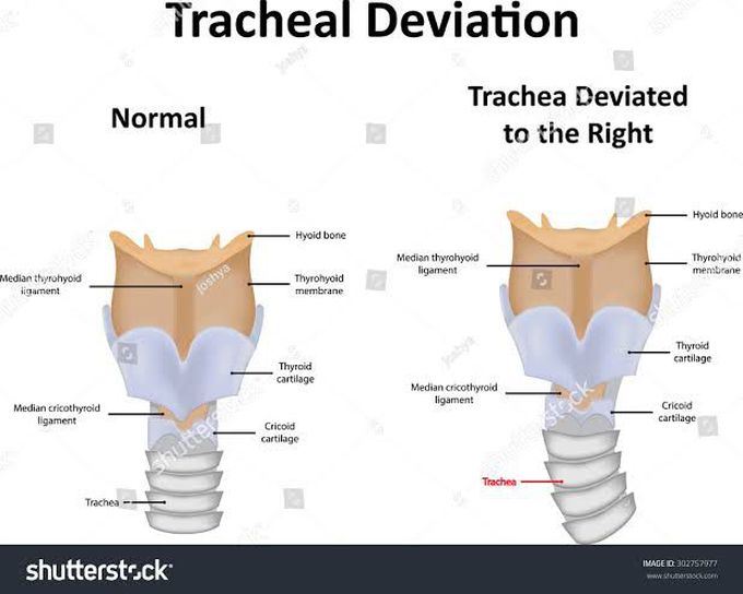 Tracheal deviation