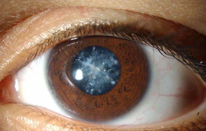 ❄ snowflake cataract in diabetes Mellitus.