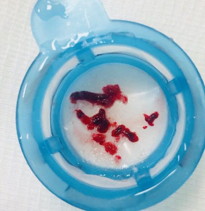 Blood clot