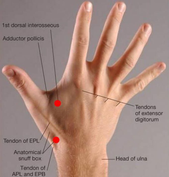 Scaphoid Fracture