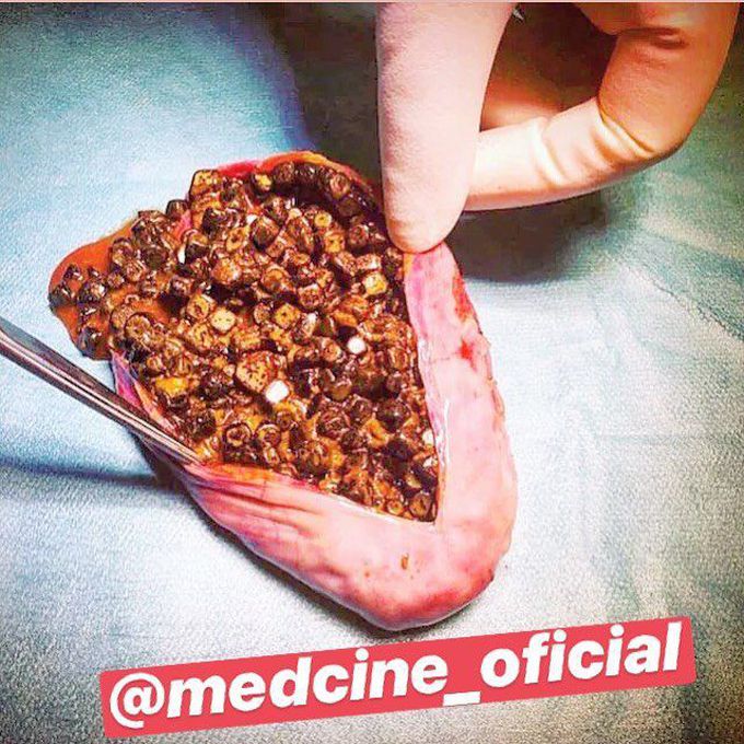Gallstones!
