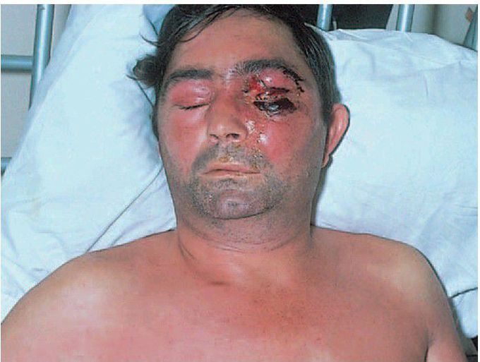 Facial cellulitis
