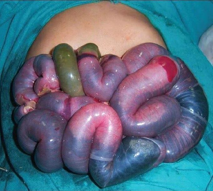 The picture shows gangrenous bowel after bowel infarction! 