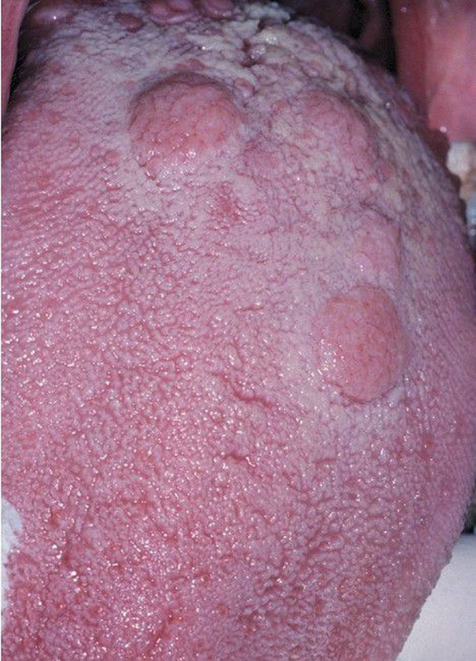Condyloma Lata.