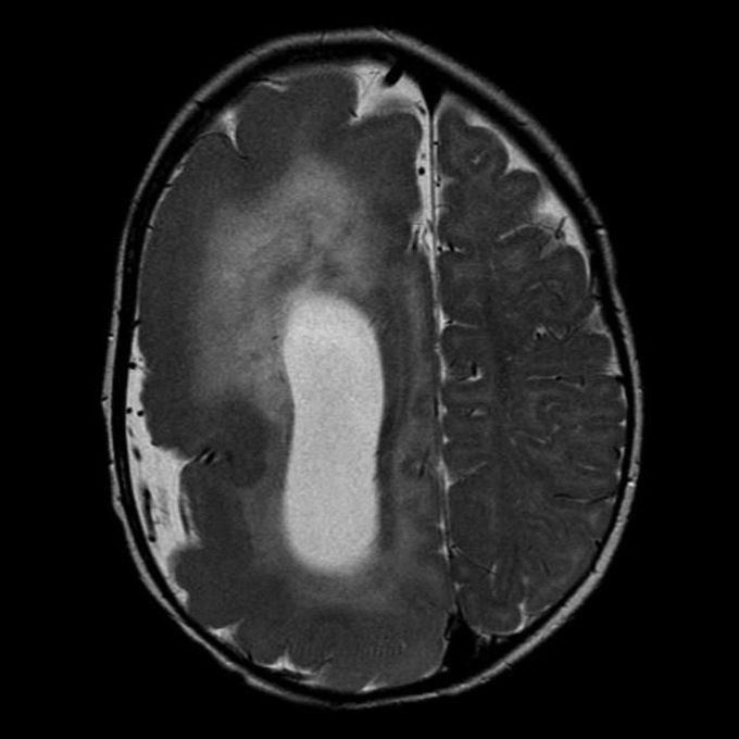 One-half of the brain abnormally bigger than the other half - that's a super rare cortical developmental disorder called hemimegalencephalgy!