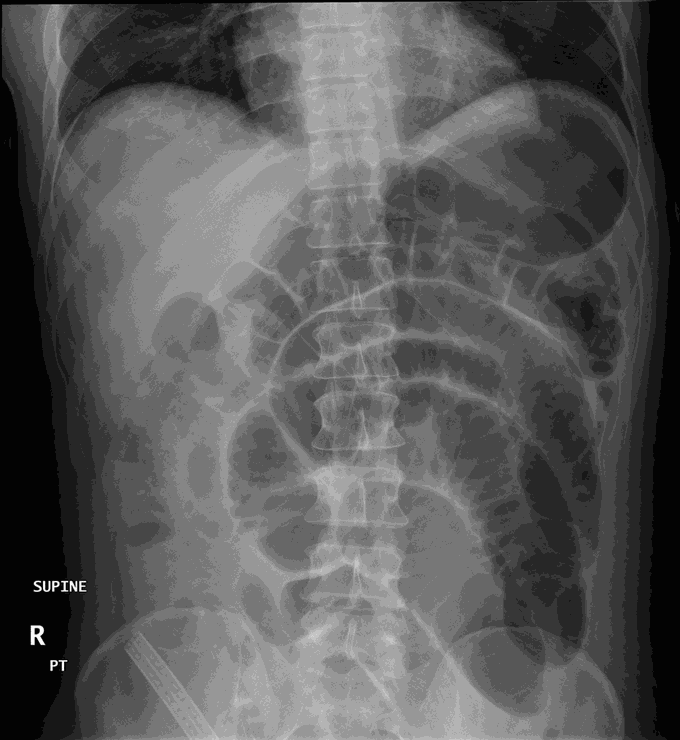 Radiological Findings in Bowel Obstruction