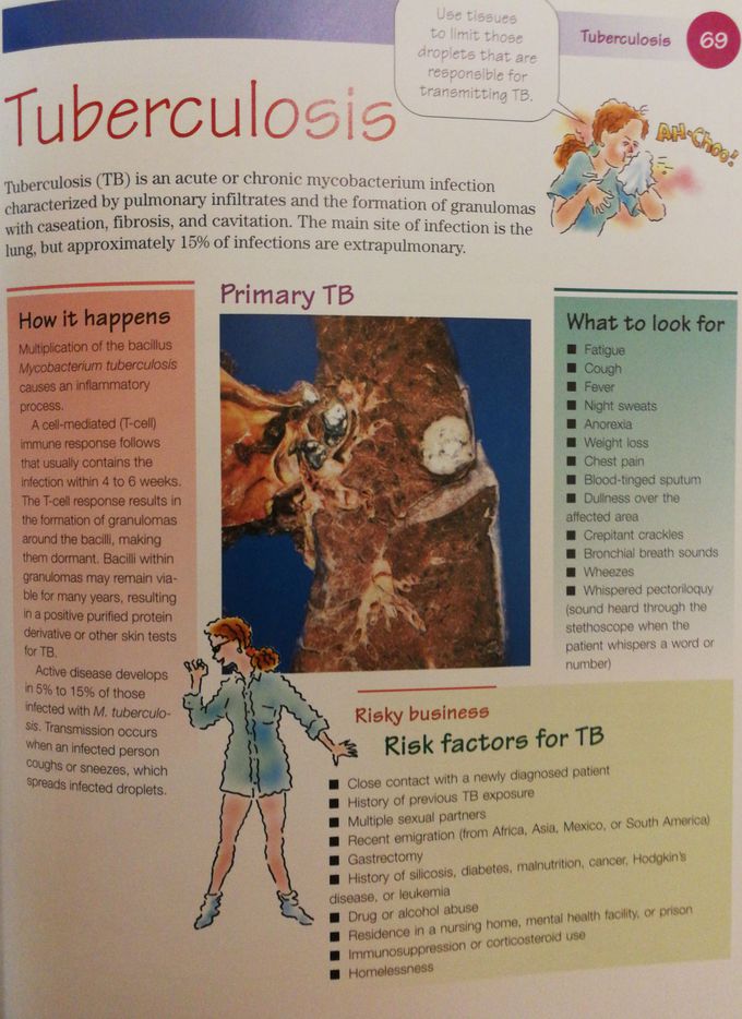 Tuberculosis