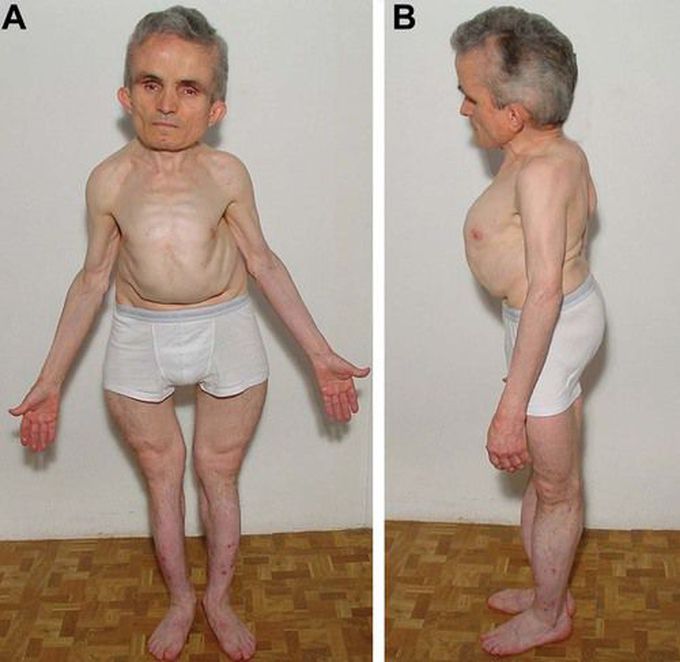 Pagets disease of bone