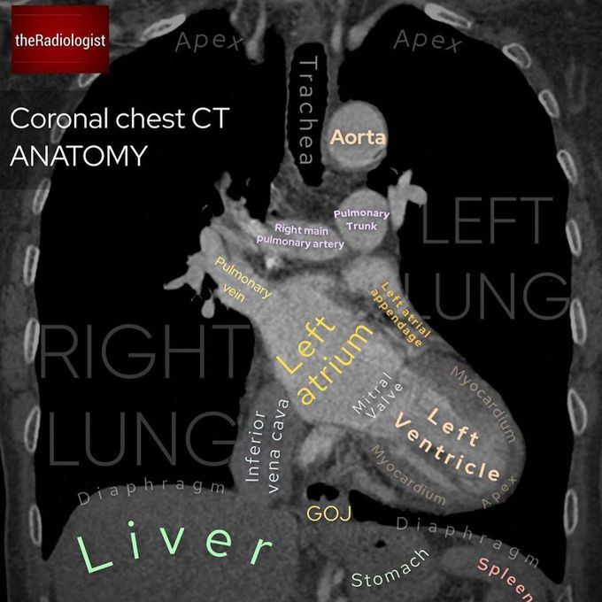 Coronal chest ct
