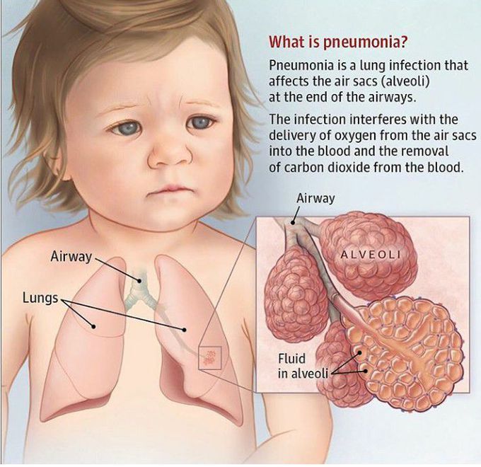 Pneumonia