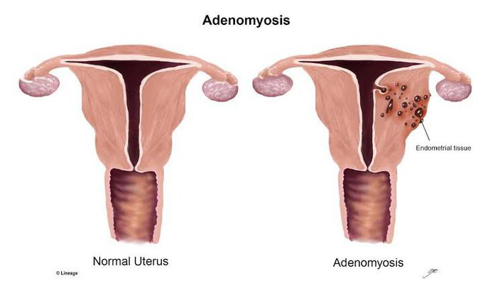 Adenomyosis