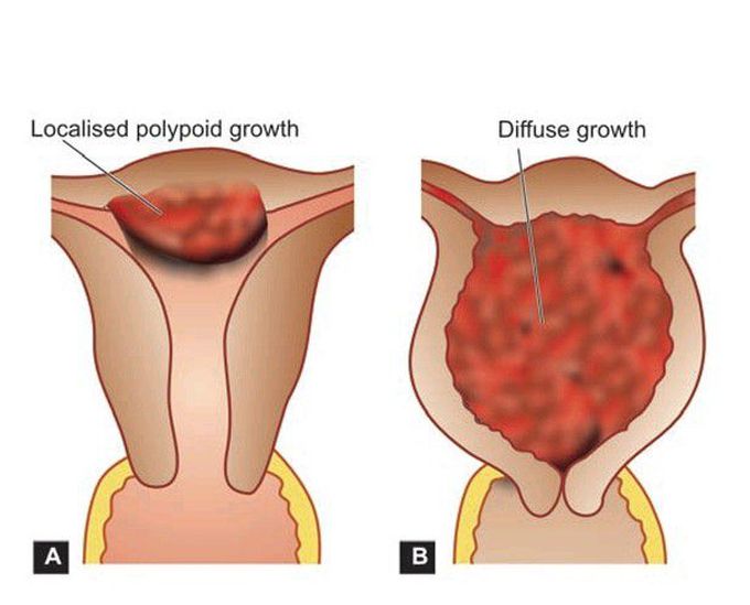 Endometrial carcinoma