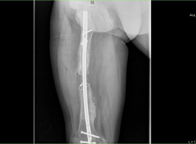 Femur