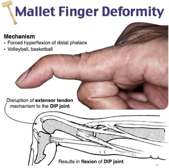 Mallet Finger Deformity
