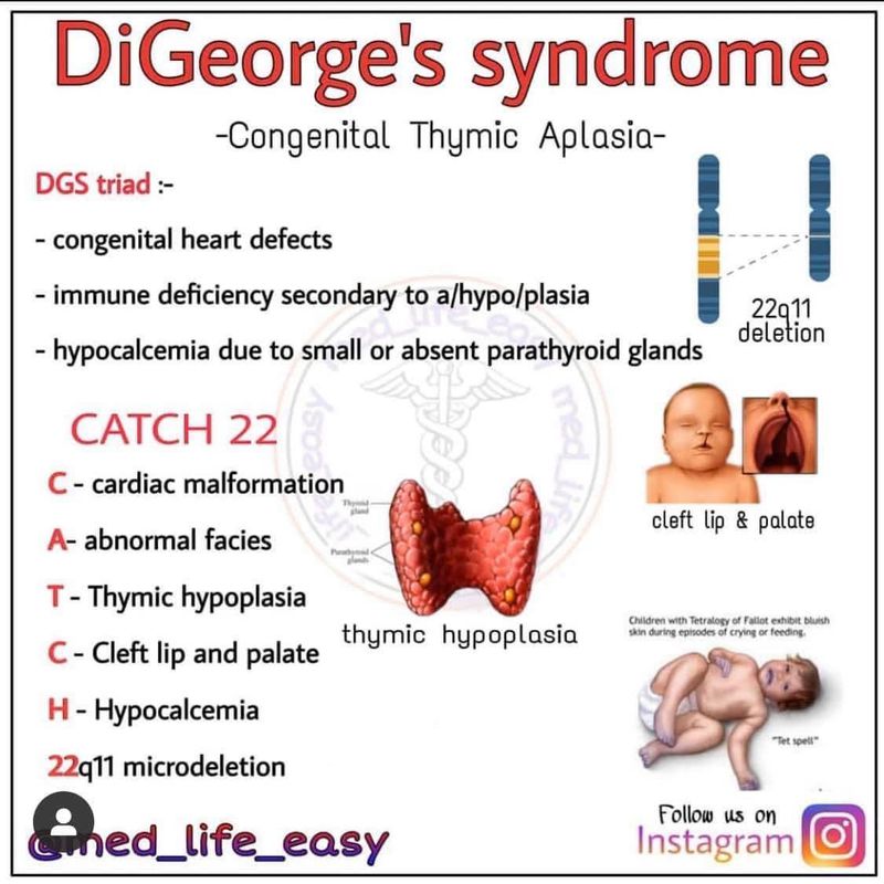 Syndrome De Digeorge Facies