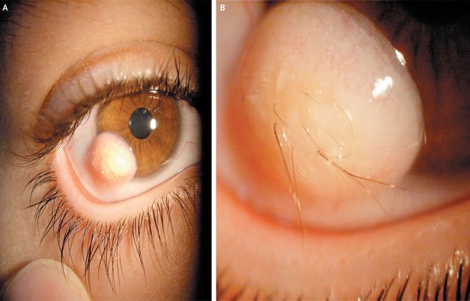The Hairy Eyeball — Limbal Dermoid