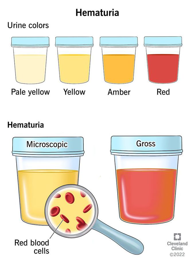 Red or pink urine