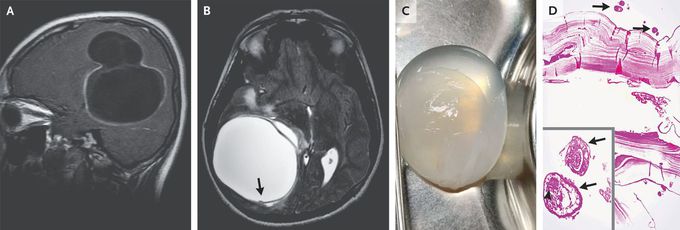 Cerebral Cystic Echinococcosis