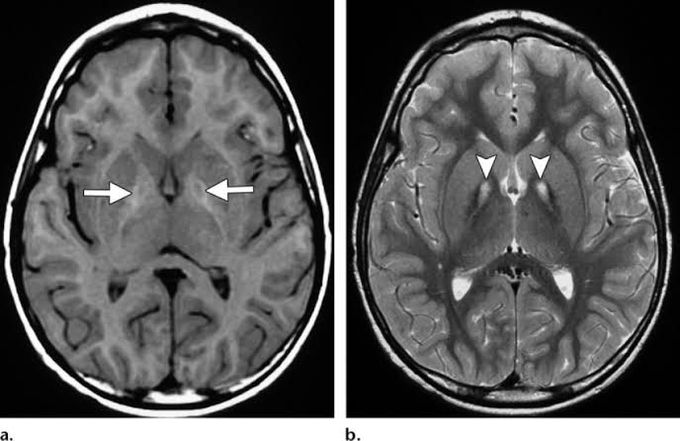 Hallervorden Spatz Syndrome