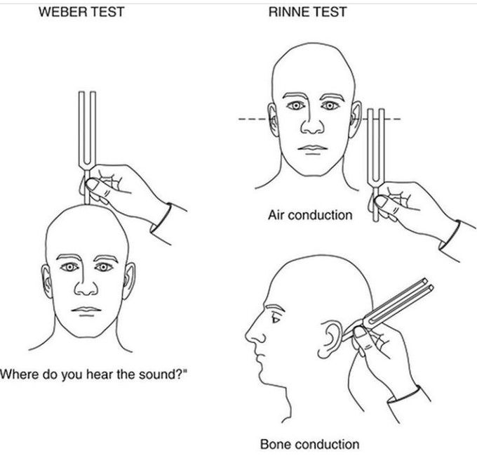 Rinne and Weber tests