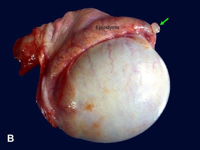 Testicular Appendages